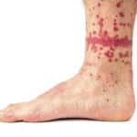 Extreme case of flea bites on humans.